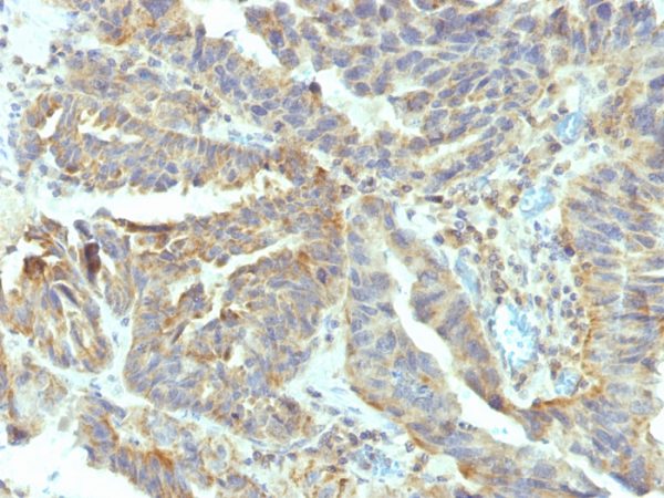 Formalin-fixed, paraffin-embedded human Ovarian Carcinoma stained with Alkaline Phosphatase Mouse Monoclonal Antibody (V17.1).