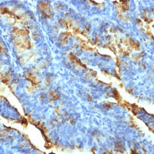 Formalin-fixed, paraffin-embedded human Uterine Carcinoma stained with FSH Receptor Mouse Monoclonal Antibody (FSHR/1400).