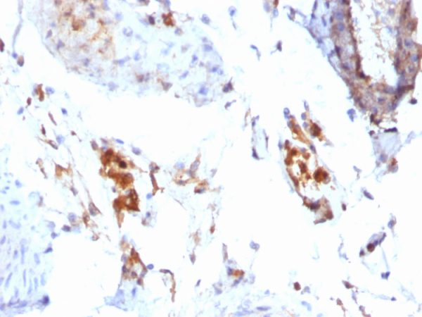 Formalin-fixed, paraffin-embedded Human Testicular Carcinoma stained with Ferritin, Light Chain Mouse Monoclonal Antibody (FTL/1386).