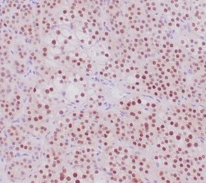 Formalin-fixed, paraffin-embedded human adrenal cortical tumor stained with SF-1 Recombinant Rabbit Monoclonal Antibody (NR5A1/4368R). HIER: Tris/EDTA, pH9.0, 45min. 2°C: HRP-polymer, 30min. DAB, 5min.