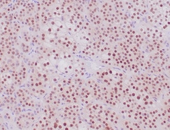 Formalin-fixed, paraffin-embedded human adrenal cortical tumor stained with SF-1 Recombinant Rabbit Monoclonal Antibody (NR5A1/4368R). HIER: Tris/EDTA, pH9.0, 45min. 2 °: HRP-polymer, 30min. DAB, 5min.
