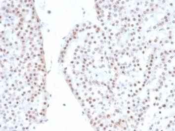 Formalin-fixed, paraffin-embedded human renal oncocytoma stained with SF-1 Recombinant Rabbit Monoclonal Antibody (NR5A1/4368R). HIER: Tris/EDTA, pH9.0, 45min. 2 °: HRP-polymer, 30min. DAB, 5min.