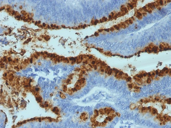 Formalin-fixed, paraffin-embedded human Colon Carcinoma stained with Blood Group Antigen Lewis B Mouse Monoclonal Antibody (2-25LE).