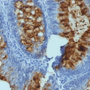 Formalin-fixed, paraffin-embedded human Colon Carcinoma stained with Blood Group Antigen Lewis B Mouse Monoclonal Antibody (SPM194).