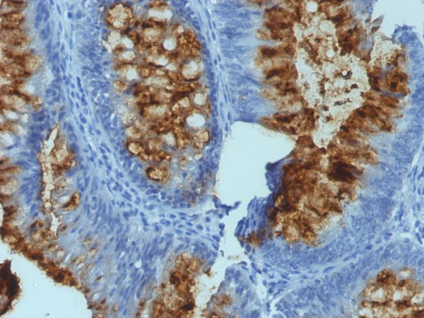 Formalin-fixed, paraffin-embedded human Colon Carcinoma stained with Blood Group Antigen Lewis B Mouse Monoclonal Antibody (SPM194).