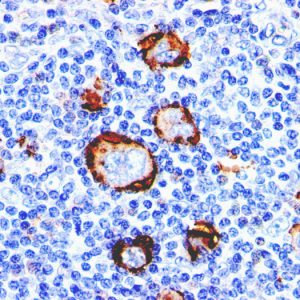 Formalin-fixed, paraffin-embedded human Hodgkin&apos;s Lymphoma stained with CD15 Monoclonal Antibody (Leu-M1).