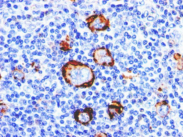 Formalin-fixed, paraffin-embedded human Hodgkin&apos;s Lymphoma stained with CD15 Monoclonal Antibody (Leu-M1).