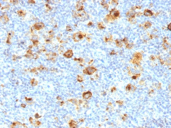 Formalin-fixed, paraffin-embedded human Hodgkin&apos;s Lymphoma stained with CD15 Mouse Monoclonal Antibody (MY-1).