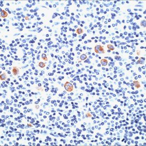 Formalin-fixed, paraffin-embedded human Hodgkin&apos;s Lymphoma stained with CD15 Monoclonal Antibody (SPM119).