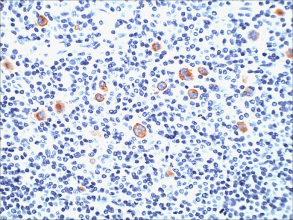 Formalin-fixed, paraffin-embedded human Hodgkin&apos;s Lymphoma stained with CD15 Monoclonal Antibody (SPM119).