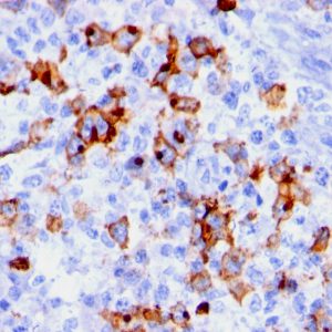 Formalin-fixed, paraffin-embedded human Hodgkin&apos;s lymphoma stained with CD15 Mouse Monoclonal Antibody (BRA-4F1).