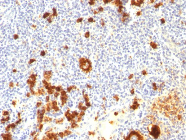 Formalin-fixed, paraffin-embedded human Hodgkin&apos;s lymphoma stained with CD15 Mouse Monoclonal Antibody (FUT4/815 + BRA-4F1).
