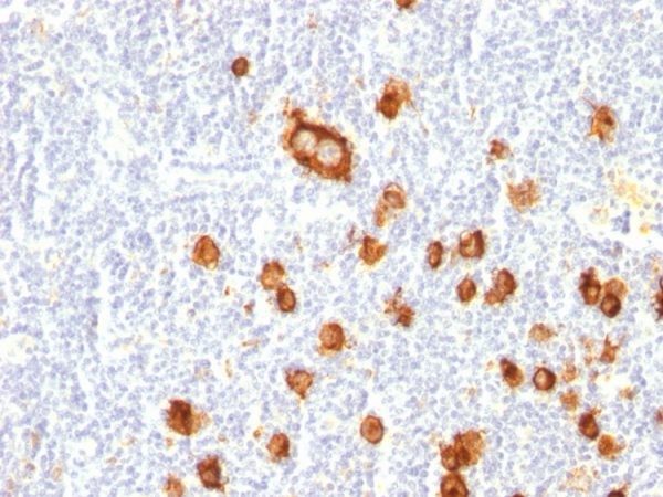 Formalin-fixed, paraffin-embedded human Hodgkin&apos;s Lymphoma stained with CD15 Mouse Monoclonal Antibody (FUT4/815).