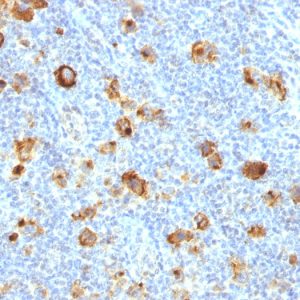 Formalin-fixed, paraffin-embedded human Hodgkin&apos;s Lymphoma stained with CD15 Rabbit Recombinant Monoclonal Antibody (FUT4/1478R).