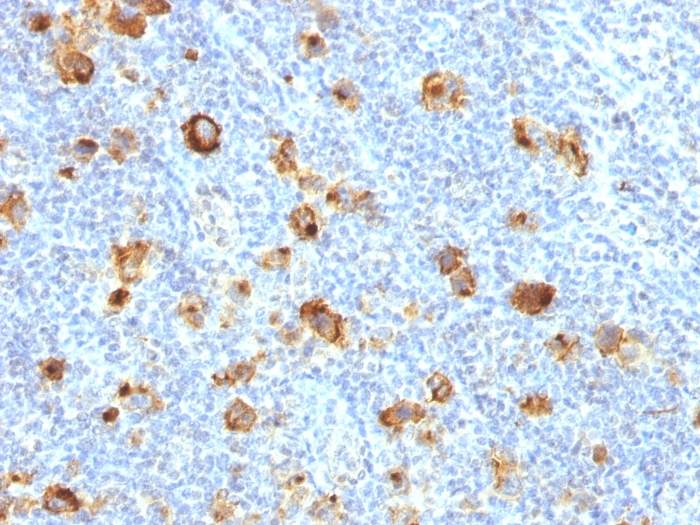 Formalin-fixed, paraffin-embedded human Hodgkin's Lymphoma stained with CD15 Rabbit Recombinant Monoclonal Antibody (FUT4/1478R). Recombinant CD15 / FUT4 (Reed-Sternberg Cell Marker) Antibody