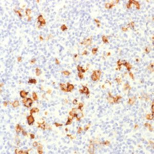 Formalin-fixed, paraffin-embedded human Hodgkin&apos;s Lymphoma stained with CD15 Rabbit Polyclonal Antibody.