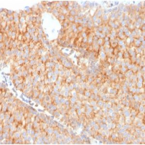 Formalin-fixed, paraffin-embedded human urothelial carcinoma stained with SERBP1 Mouse Monoclonal Antibody (SERBP1/3491).