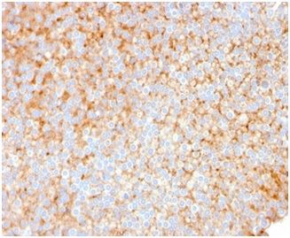 Formalin-fixed, paraffin-embedded human urothelial carcinoma stained with SERBP1 Mouse Monoclonal Antibody (SERBP1/3491).