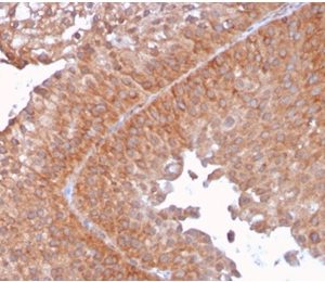 Formalin-fixed, paraffin-embedded human urothelial carcinoma stained with SERBP1 Mouse Monoclonal Antibody (SERBP1/3492).