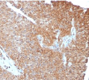 Formalin-fixed, paraffin-embedded human urothelial carcinoma stained with SERBP1 Mouse Monoclonal Antibody (SERBP1/3493).