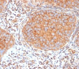 Formalin-fixed, paraffin-embedded human urothelial carcinoma stained with SERBP1 Mouse Monoclonal Antibody (SERBP1/3494).