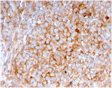 Formalin-fixed, paraffin-embedded human urothelial carcinoma stained with SERBP1 Mouse Monoclonal Antibody (SERBP1/3495).