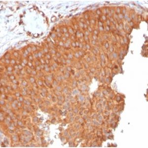 Formalin-fixed, paraffin-embedded human urothelial carcinoma stained with PAI-RBP1 Mouse Monoclonal Antibody (SERBP1/3496).