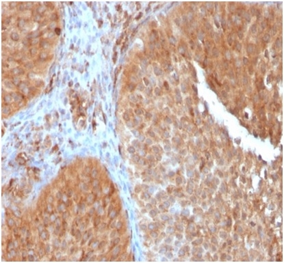 Formalin-fixed, paraffin-embedded human urothelial carcinoma stained with SERBP1 Mouse Monoclonal Antibody (SERBP1/3497).