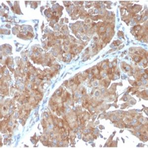 Formalin-fixed, paraffin-embedded human urothelial carcinoma stained with SERBP1 Mouse Monoclonal Antibody (SERBP1/3498).