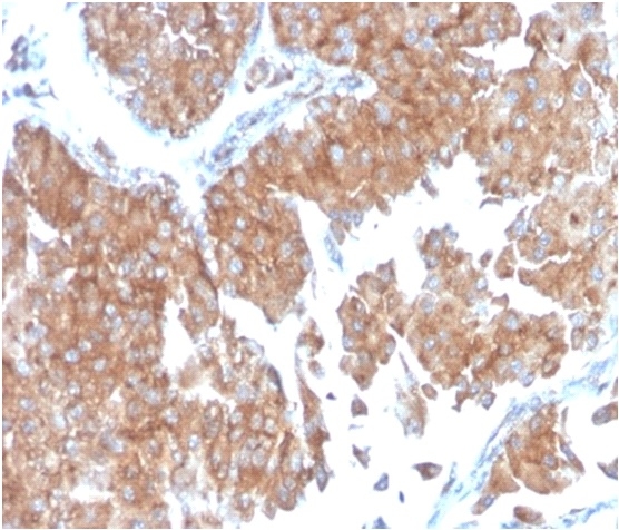 Formalin-fixed, paraffin-embedded human urothelial carcinoma stained with SERBP1 Mouse Monoclonal Antibody (SERBP1/3498).