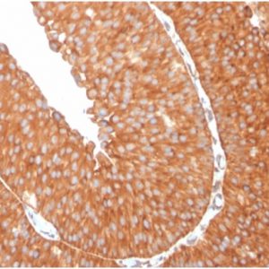 Formalin-fixed, paraffin-embedded human urothelial carcinoma stained with SERBP1 Mouse Monoclonal Antibody (SERBP1/3509).