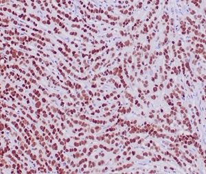 Formalin-fixed, paraffin-embedded human lobular breast carcinoma stained with GATA-3 Recombinant Mouse Monoclonal Antibody (rGATA3/3870). HIER: Tris/EDTA, pH9.0, 45min. 2°C: HRP-polymer, 30min. DAB, 5min.