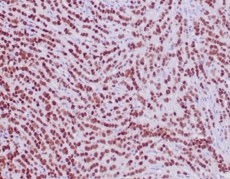 Formalin-fixed, paraffin-embedded human lobular breast carcinoma stained with GATA-3 Recombinant Mouse Monoclonal Antibody (rGATA3/3870). HIER: Tris/EDTA, pH9.0, 45min. 2°C: HRP-polymer, 30min. DAB, 5min.