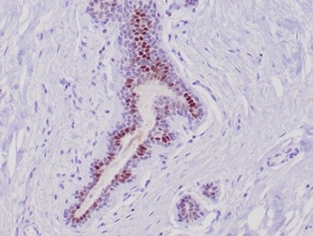 Formalin-fixed, paraffin-embedded human lobular breast carcinoma stained with GATA-3 Mouse Monoclonal Antibody (GATA3/6664) at 2ug/ml. HIER: Tris/EDTA, pH9.0, 45min. 2 °: HRP-polymer, 30min. DAB, 5min.