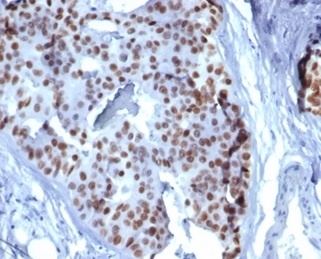 Formalin-fixed, paraffin-embedded human lobular breast carcinoma stained with GATA-3 Mouse Monoclonal Antibody (GATA3/6664).