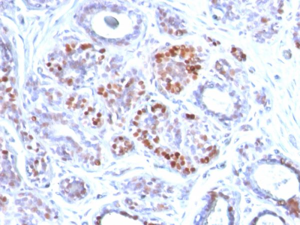 Formalin-fixed, paraffin-embedded human Breast Carcinoma stained with GATA-3 Mouse Monoclonal Antibody (GATA3/2442).
