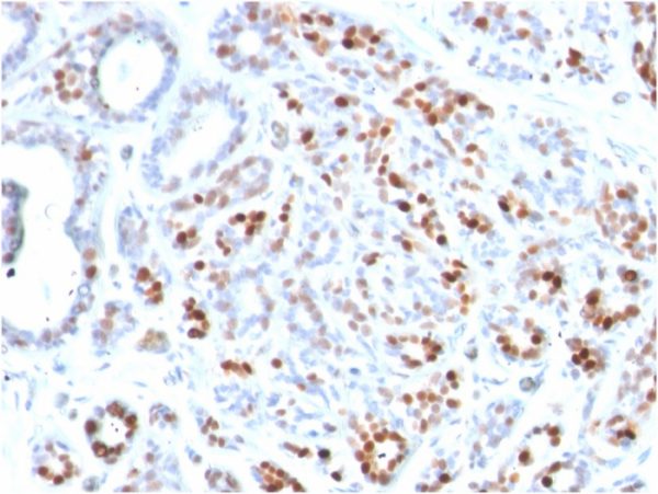 Formalin-fixed, paraffin-embedded human Breast Carcinoma stained with GATA-3 Mouse Monoclonal Antibody (GATA3/2444).