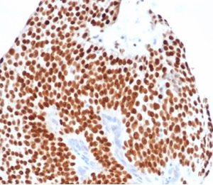 Formalin-fixed, paraffin-embedded human bladder carcinoma stained with GATA-3 Recombinant Rabbit Monoclonal Antibody (GATA3/4550R).