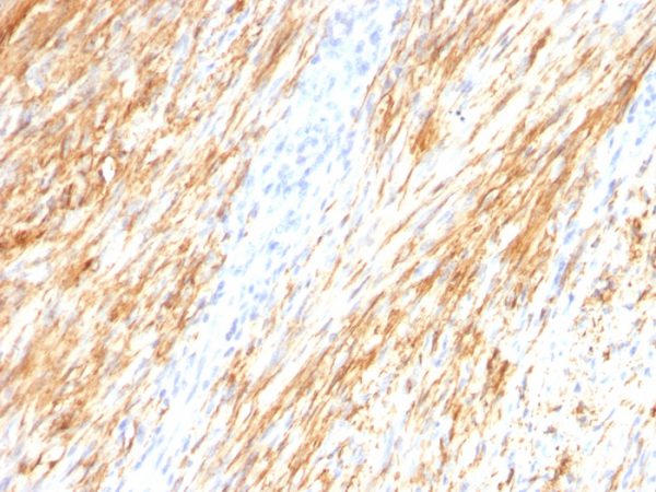 Formalin-fixed, paraffin-embedded human Schwanoma stained with GFAP Mouse Monoclonal Antibody (ASTRO/789).