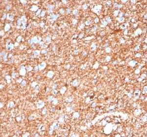 Formalin-fixed, paraffin-embedded human brain stained with GFAP Mouse Monoclonal Antibody (GFAP/6884). HIER: Tris/EDTA, pH9.0, 45min. 2 °: HRP-polymer, 30min. DAB, 5min.