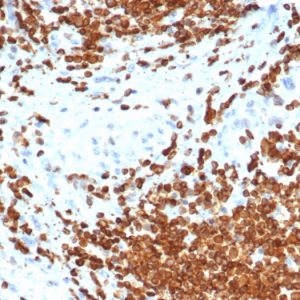 IHC analysis of formalin-fixed, paraffin-embedded human bladder carcinoma. AMH/6713R at 2ug/ml in PBS for 30min RT. HIER: Tris/EDTA, pH9.0, 45min. 2°C: HRP-polymer, 30min. DAB, 5min.