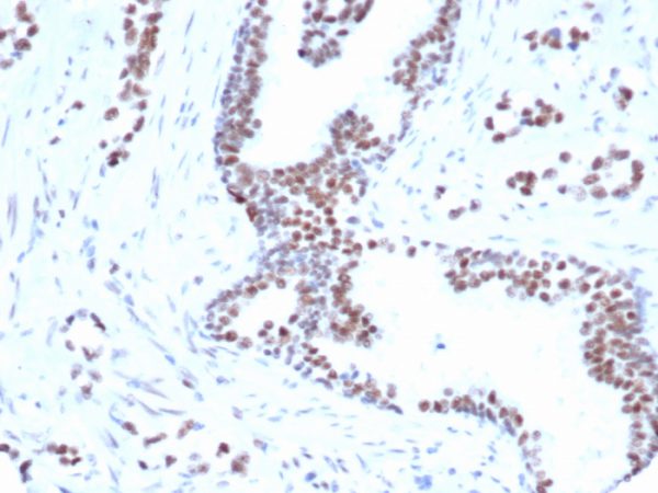 Formalin-fixed, paraffin-embedded human prostate carcinoma stained with FOXP1 Recombinant Mouse Monoclonal Antibody (rFOXP1/6902) [1ug/ml in PBS] for 30min RT. HIER: Tris/EDTA, pH9.0, 45min. 2°C: HRP-polymer, 30min. DAB, 5min