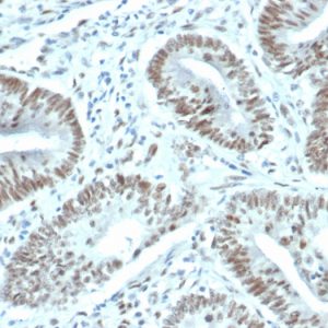 Formalin-fixed, paraffin-embedded human prostate carcinoma stained with FOXP1 Recombinant Rabbit Monoclonal Antibody (FOXP1/44R) [1ug/ml in PBS] for 30min RT. HIER: Tris/EDTA, pH9.0, 45min. 2°C: HRP-polymer, 30min. DAB, 5min.