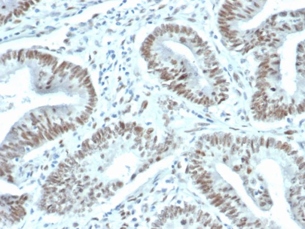 Formalin-fixed, paraffin-embedded human prostate carcinoma stained with FOXP1 Recombinant Rabbit Monoclonal Antibody (FOXP1/44R) [1ug/ml in PBS] for 30min RT. HIER: Tris/EDTA, pH9.0, 45min. 2°C: HRP-polymer, 30min. DAB, 5min.