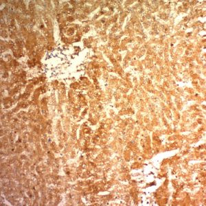 Formalin-fixed, paraffin-embedded human Hepatocellular Carcinoma (HCC) stained with Glypican-3 Monoclonal Antibody (1G12)