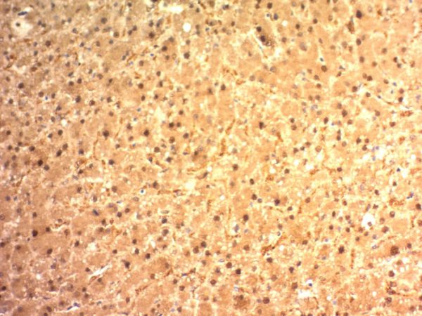 Formalin-fixed, paraffin-embedded human Hepatocellular Carcinoma stained with Glypican-3 Mouse Monoclonal Antibody (SPM595).