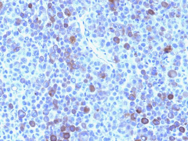 Formalin-fixed, paraffin-embedded human Melanoma stained with Glypican-3 Mouse Monoclonal Antibody (GPC3/863)