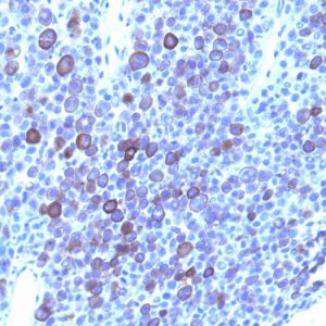 Formalin-fixed, paraffin-embedded human Melanoma stained with Glypican-3 Monoclonal Antibody (1G12 + GPC3/863).