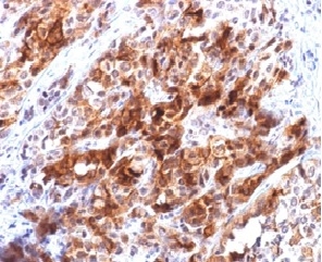 Formalin-fixed, paraffin-embedded human hepatocellular carcinoma stained with Glypican-3 Mouse Recombinant Monoclonal Antibody (rGPC3/863).