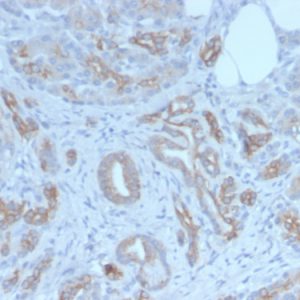 Formalin-fixed, paraffin-embedded human breast carcinoma stained with  GLG1 Recombinant Rabbit Monoclonal Antibody (GLG1/7174R).
